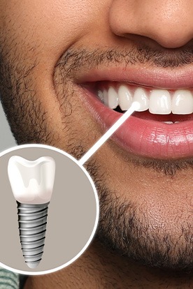 a closeup of a patient’s smile with dental implants