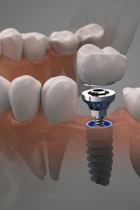 a 3D illustration of the parts of a dental implant